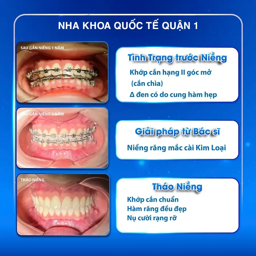 Trước và sau khi niềng