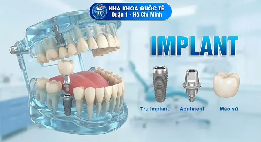 Hình minh họa cấu tạo răng implant