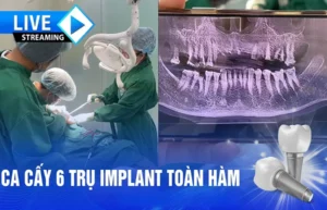 cấy 6 trụ implant