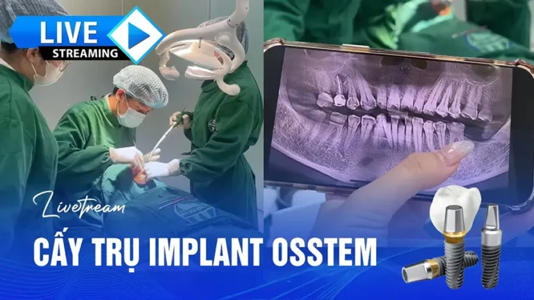 cấy trụ OSSTEM