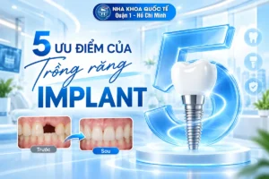 5 ưu điểm của trồng implant