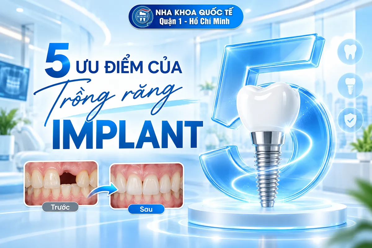 5 ưu điểm của trồng implant